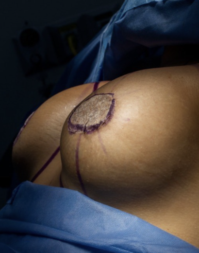 Mastopexia Dr Julian Pacheco